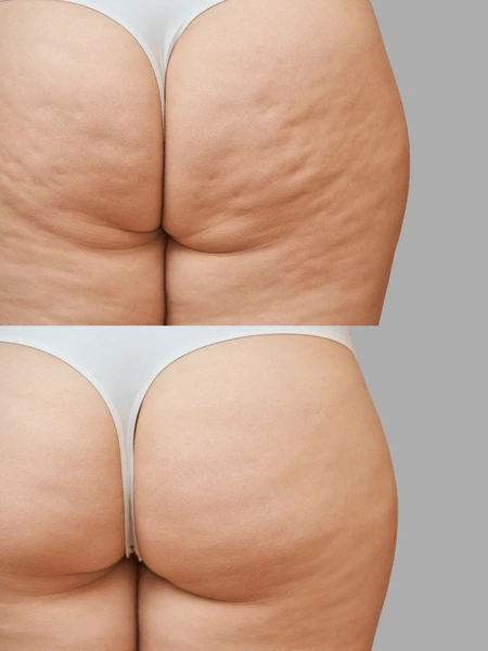 body contouring transformation